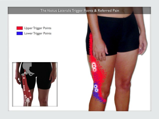 trps-and-referred-pain-vastus-lateralis-1024x768